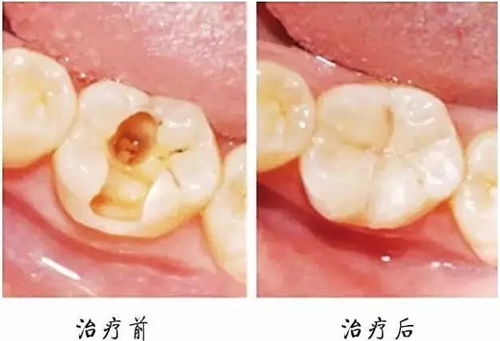 益开食说蛀牙 牙齿痛了再看牙医,就痛苦加倍,花费加N倍