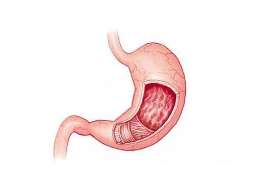 太可怕,胃也会慢慢烂掉 糜烂性胃炎究竟是怎么一回事 