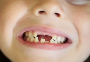 因为 牙齿漏风 孩子再不想唱歌 这些孩子都可能被牙齿 毁容