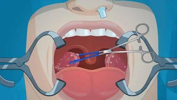 扁桃体该不该切 医生说 看完你就明白了