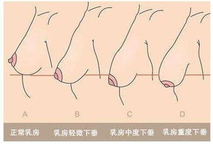 怎样防止产后乳房下垂 