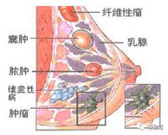 乳腺增生 囊肿和结节,保险的核保条件 