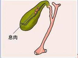 胆囊息肉究竟是什么 要手术吗