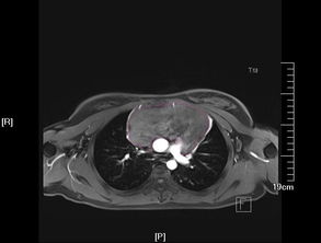 巨大纵膈肿瘤外科治疗 巨大侵袭性胸腺瘤的完整切除