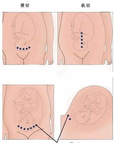 剖腹产横切好还是竖切好 对二胎有什么影响