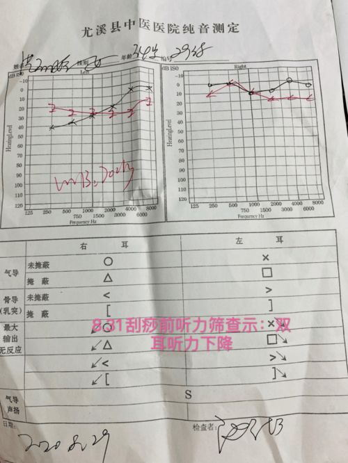 李氏砭法 砭治突发性耳鸣伴听力下降