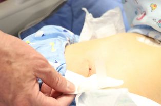 女婴出生4天确诊先心病 针眼小伤口封堵房间隔缺损 