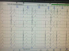 holter所见心律失常 心血管内科讨论版 爱爱医医学论坛 