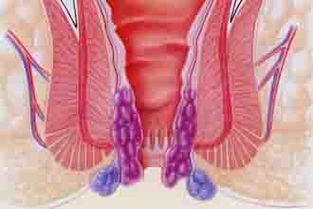 十人九痔,看看你是不是中招了 痔疮预防 
