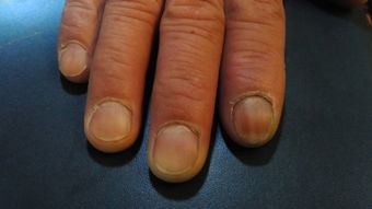 手指甲盖凹凸不平而且呈黑色什么原因 