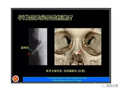 鼻骨孔 鼻骨骨折诊断的误区