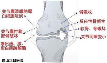 为什么容易骨质增生 骨刺 主要原因是什么