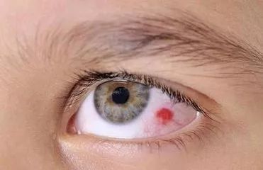 眼睛出血是什么原因(高血压导致眼睛出血是什么原因)