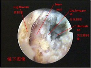 椎间孔镜微小创伤治疗腰腿痛 