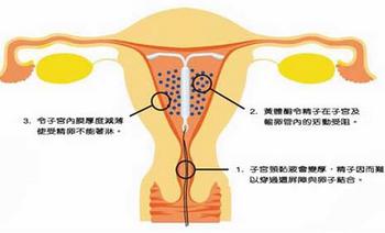 子宫腺肌症大概多少钱完全治愈