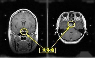 记住这些影像特点 颅内肿瘤就不怕诊断错误了