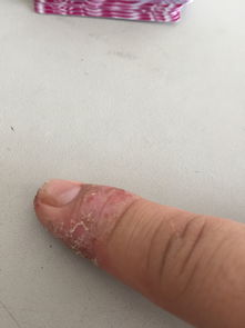手指的食指指甲位置一直起皮,有时还有小不分化脓,是怎么了,需要吃什么药,或者外用什么药来治疗,有好 