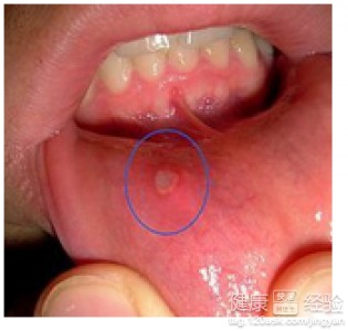 治疗口腔溃疡的最佳方法大全 信息阅读欣赏 信息村 K0w0m Com