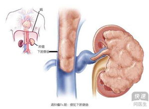 中医能治肾癌吗 四个中医疗法缓解肾癌症状