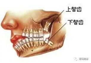 医生,为什么拔完智齿后,我变得傻傻的 拔智齿会影响智商吗