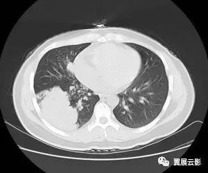肺癌与肺结核 浸润性肺腺癌之间的鉴别 