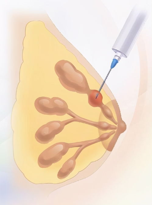 乳腺结节,穿刺活检还是切除活检