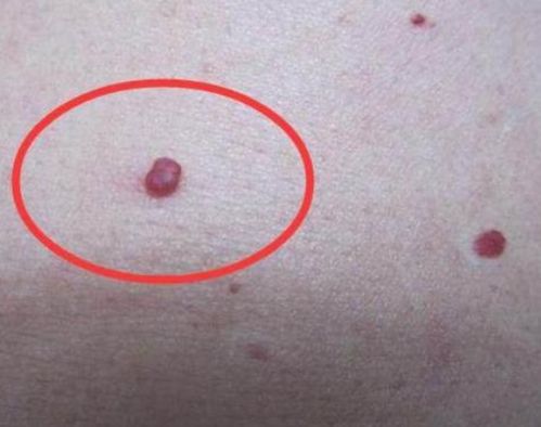 女性身上这1处长 小红点 ,或是HPV,建议定期检查身体