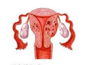 什么是子宫腺肌症,会影响怀孕吗 