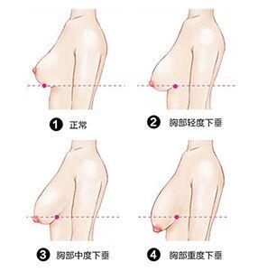 杭州乳房下垂的原因有什么呢 