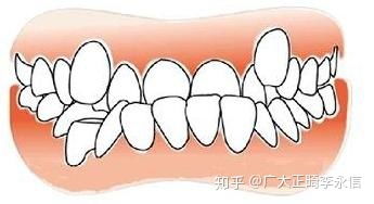 牙齿矫正时戴的小皮筋,有什么用 可以不戴吗 