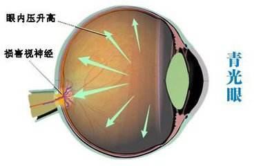 祖传 的青光眼 8岁男孩视物模糊疼痛难忍,或是来自爷爷遗传
