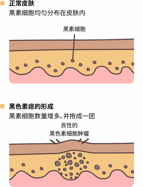 手背各部位长痣的含义