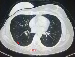 她乳腺癌手术后发现肺结节,才5毫米大,医生却建议手术 