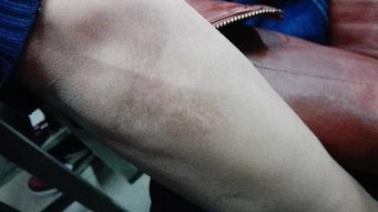 我手臂这个擦伤的疤痕会影响当兵吗 