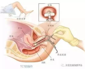 为什么不建议20多岁检查tct(得了hpv自己有啥感觉吗)