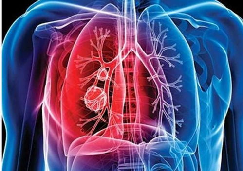 肺部疾病有哪些,又有哪些症状,我们该怎么办