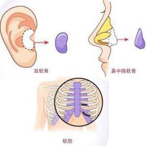 自体肋软骨综合隆鼻,了解一下