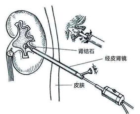 不能做体外碎石 这两种治疗方式效果佳创伤小,成功率可达100