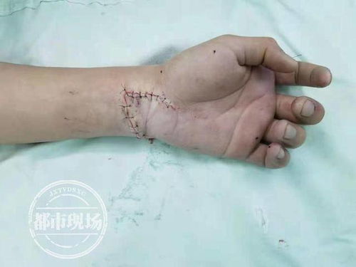 江西 高一学生手腕被人砍断 起因是女同学给他取外号