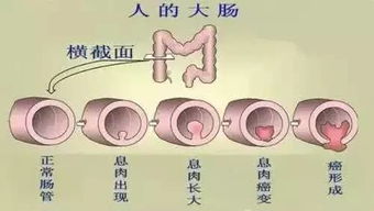 对肠息肉就要狠心,发现了必须要切除