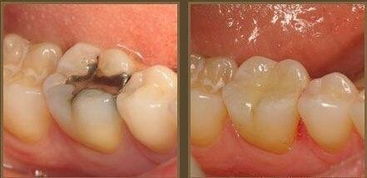 牙齿明明只烂了一半 为什么牙医却说不能补牙
