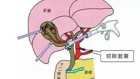 胆囊腺肌症需要切除胆囊吗(胆囊腺肌症必须手术切除吗)