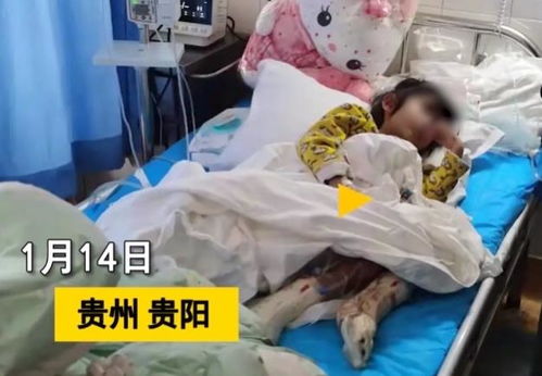 贵州的4岁女孩,被后妈毒打浑身是伤,脚被烧得露出骨头