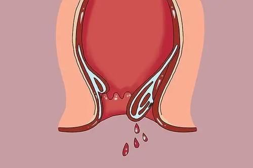 痔疮便血怎么办 痔疮患者自用药膏大测评 抑制便血萎缩肉球不再话下