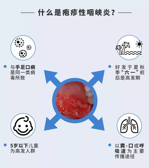 咽颊炎疱疹一般几天能恢复,疱疹性咽颊炎输液后多久可以好