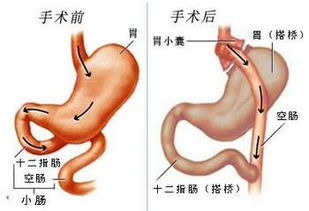 5种常用疗法可治疗2型糖尿病 