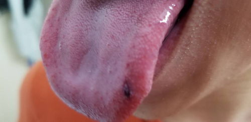 舌头上有红色的小肉粒？舌头上有红色小肉粒怎么治