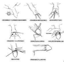 什麼季節做包皮環切術最好？ 山東臨沂