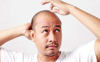 秃顶是什么原因引起的 特别是第三种无法逆转 