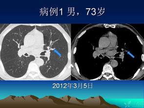 早期肺癌易漏诊征象浅析 附6例病例